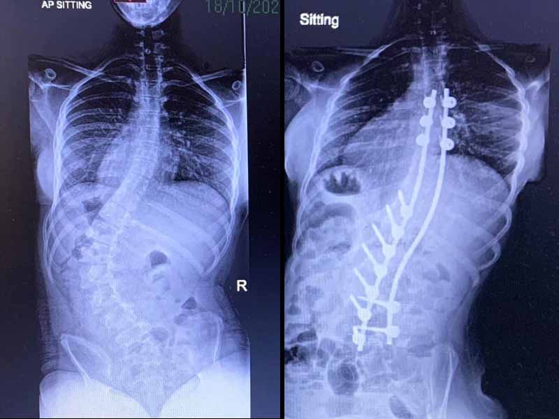 X-rays of Katie Robertson's spine before (left) and after the operation to alleviate her scoliosis condition.